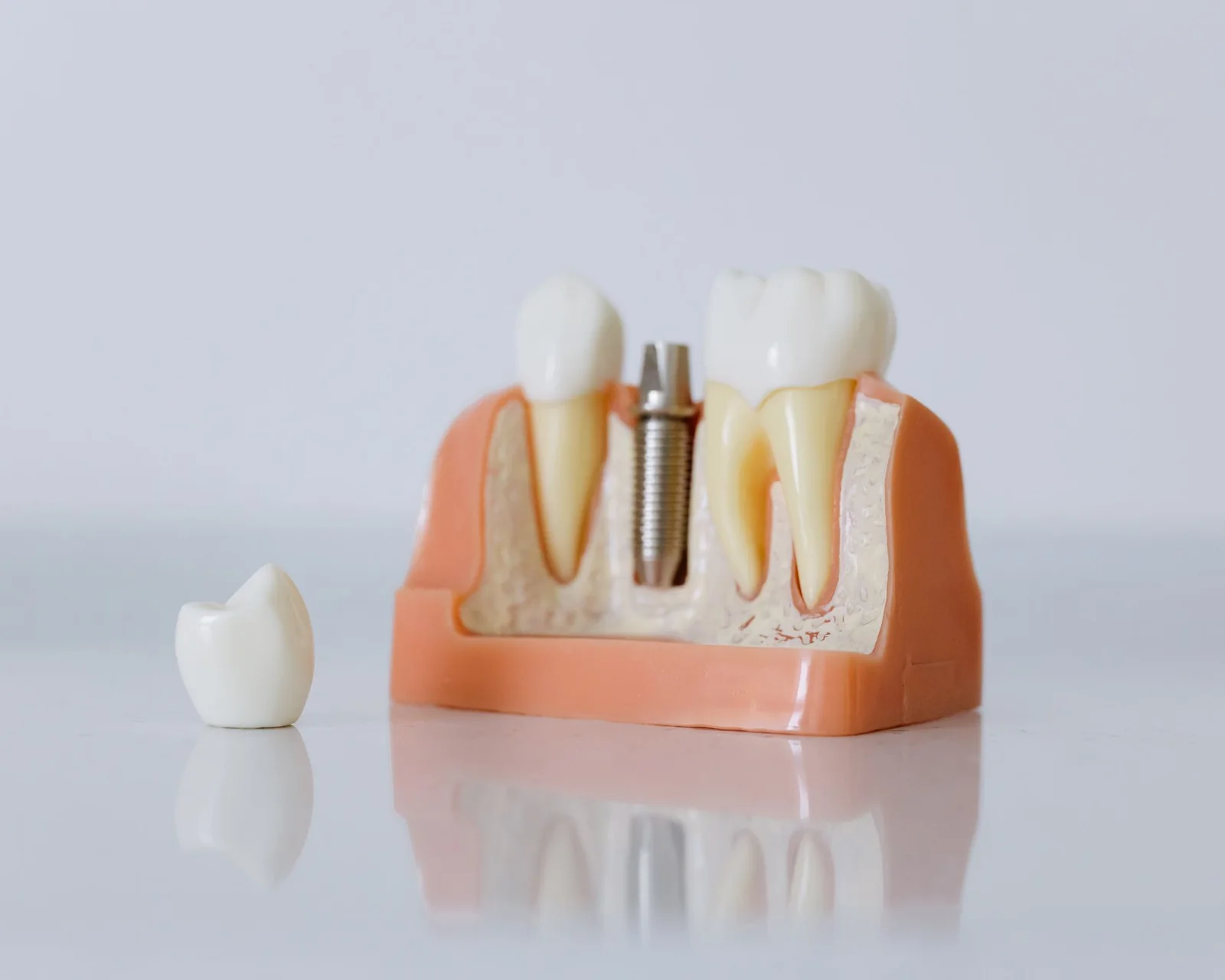 Close-up dental implant model showing prosthetic teeth and jaw structure