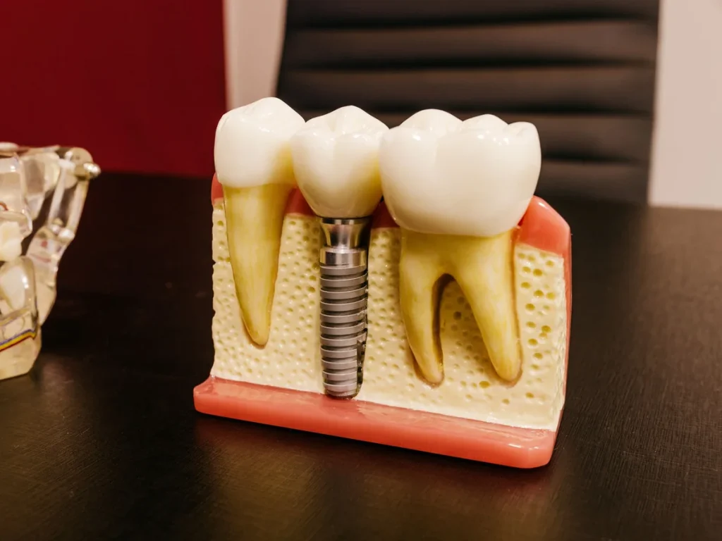 Dental implant model with a prosthetic crown and implant screw
